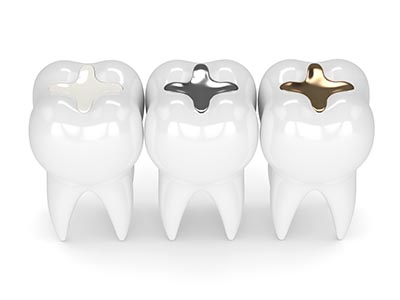 Tooth Colored Fillings